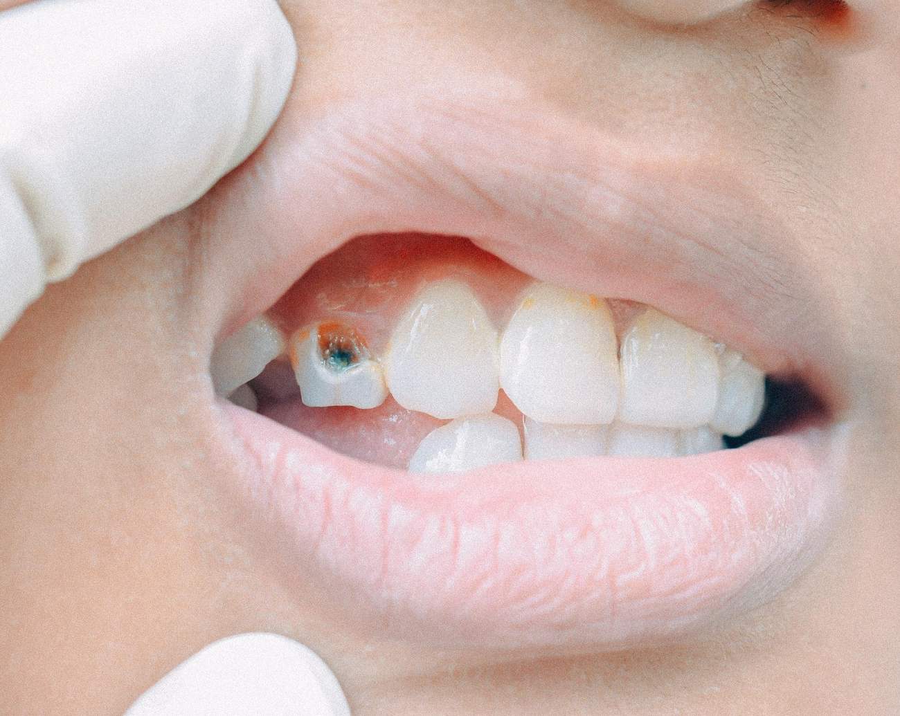Cárie Dentária: Saiba como ela se forma e como evita-la