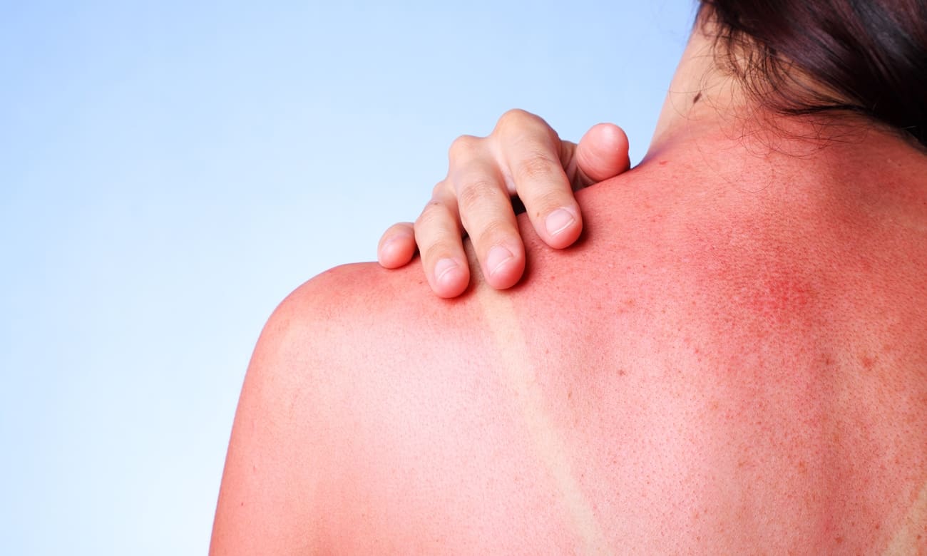 Por que a pele fica vermelha quando é exposta ao sol?