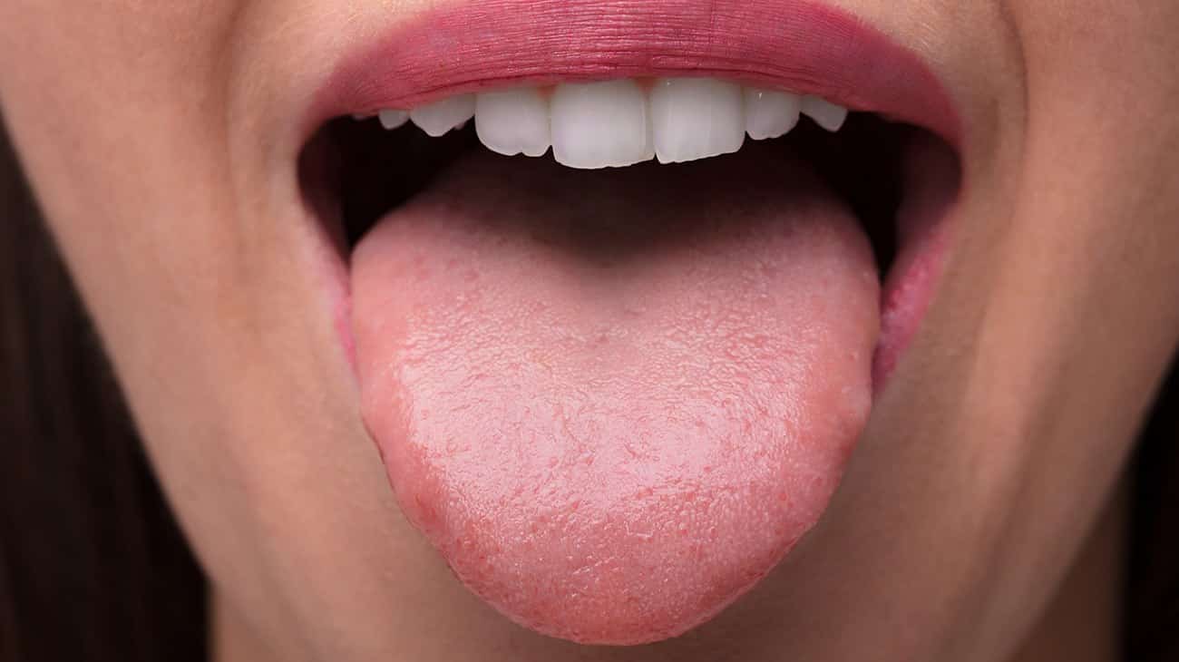 Por que a língua fica branca?